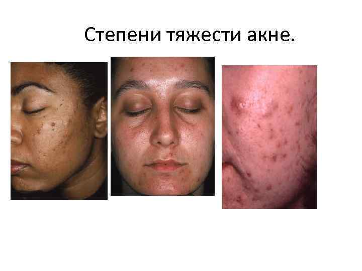 Степени тяжести акне. 