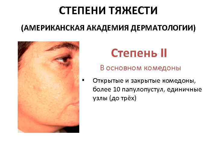 СТЕПЕНИ ТЯЖЕСТИ (АМЕРИКАНСКАЯ АКАДЕМИЯ ДЕРМАТОЛОГИИ) Степень II В основном комедоны • Открытые и закрытые