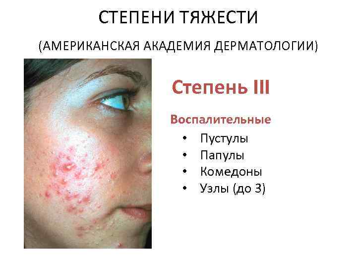 СТЕПЕНИ ТЯЖЕСТИ (АМЕРИКАНСКАЯ АКАДЕМИЯ ДЕРМАТОЛОГИИ) Степень III Воспалительные • Пустулы • Папулы • Комедоны