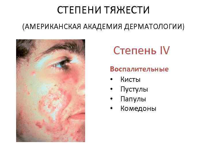 СТЕПЕНИ ТЯЖЕСТИ (АМЕРИКАНСКАЯ АКАДЕМИЯ ДЕРМАТОЛОГИИ) Степень IV Воспалительные • Кисты • Пустулы • Папулы