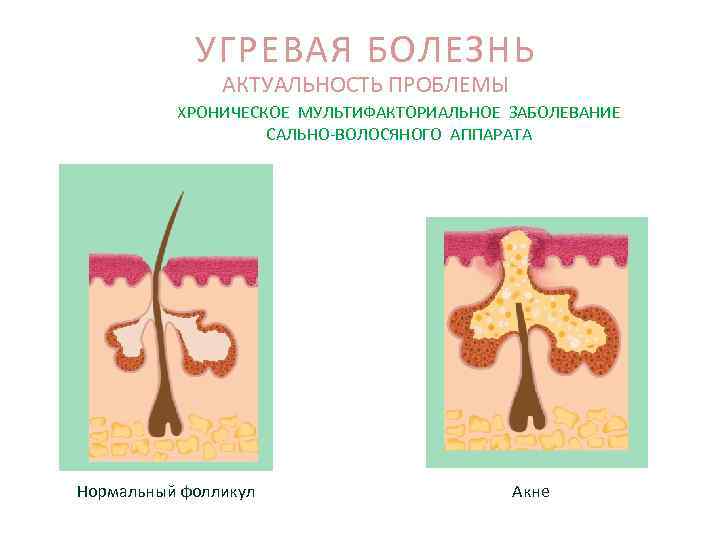 УГРЕВАЯ БОЛЕЗНЬ АКТУАЛЬНОСТЬ ПРОБЛЕМЫ ХРОНИЧЕСКОЕ МУЛЬТИФАКТОРИАЛЬНОЕ ЗАБОЛЕВАНИЕ САЛЬНО-ВОЛОСЯНОГО АППАРАТА Нормальный фолликул Акне 