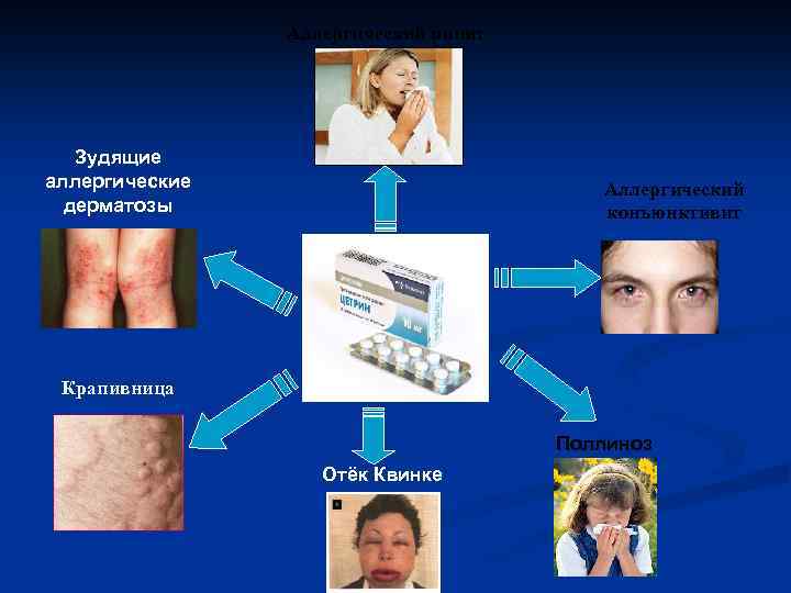Аллергический ринит Зудящие аллергические дерматозы Аллергический конъюнктивит Крапивница Поллиноз Отёк Квинке 