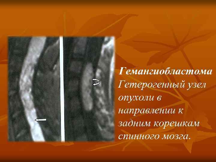 Гемангиобластома Гетерогенный узел опухоли в направлении к задним корешкам спинного мозга. 