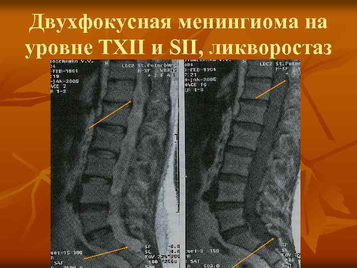 Двухфокусная менингиома на уровне ТХІІ и SII, ликворостаз 
