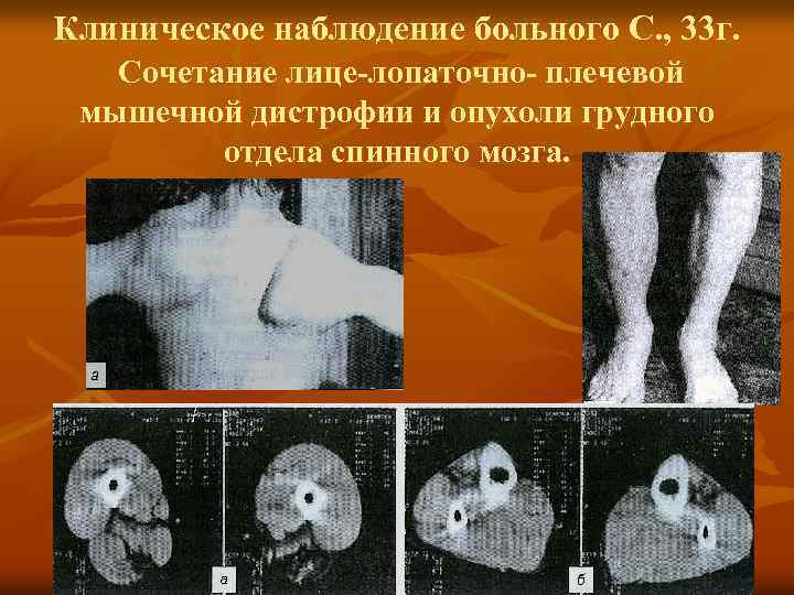 Клиническое наблюдение больного С. , 33 г. Сочетание лице-лопаточно- плечевой мышечной дистрофии и опухоли
