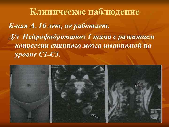 Клиническое наблюдение Б-ная А. 16 лет, не работает. Д/з Нейрофиброматоз 1 типа с развитием