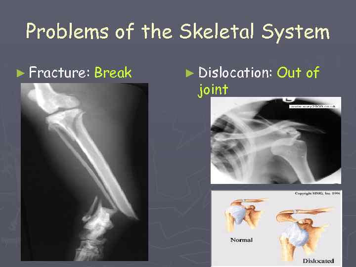 Problems of the Skeletal System ► Fracture: Break ► Dislocation: joint Out of 