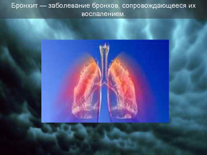 Бронхит — заболевание бронхов, сопровождающееся их воспалением. 