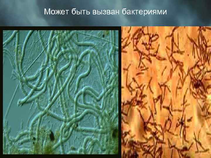 Может быть вызван бактериями 
