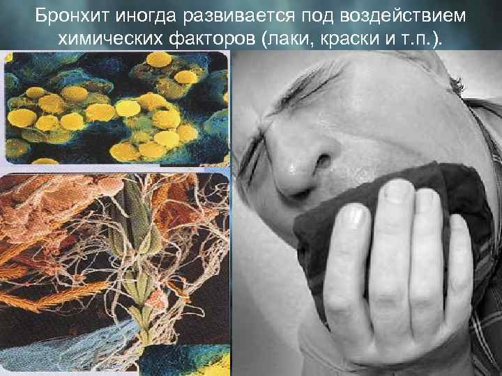 Бронхит иногда развивается под воздействием химических факторов (лаки, краски и т. п. ). 