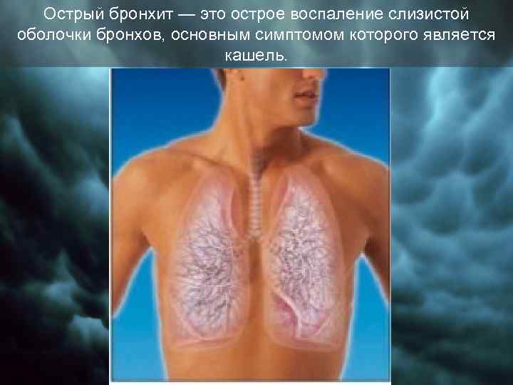 Острый бронхит — это острое воспаление слизистой оболочки бронхов, основным симптомом которого является кашель.