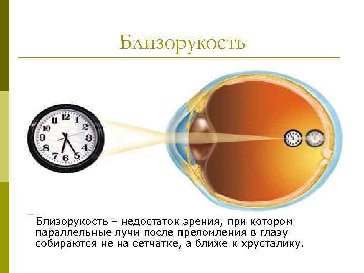 Близорукость – недостаток зрения, при котором параллельные лучи после преломления в глазу собираются не