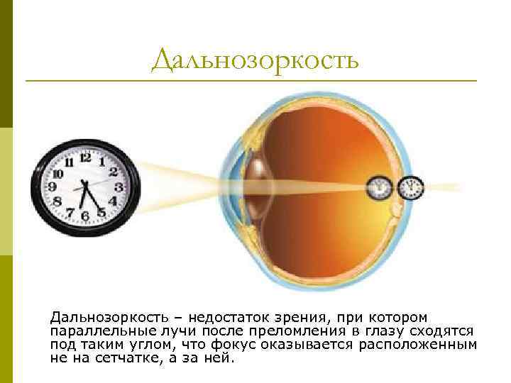 Дальнозоркость – недостаток зрения, при котором параллельные лучи после преломления в глазу сходятся под