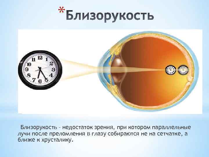 * Близорукость – недостаток зрения, при котором параллельные лучи после преломления в глазу собираются