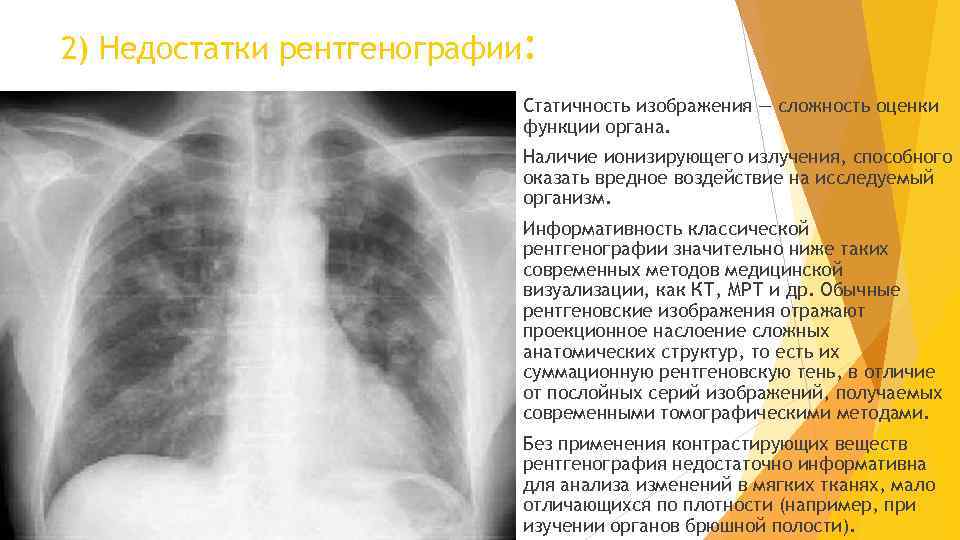 2) Недостатки рентгенографии: Статичность изображения — сложность оценки функции органа. Наличие ионизирующего излучения, способного