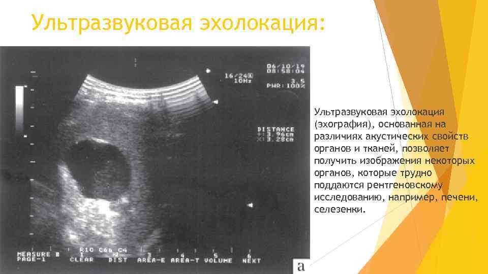 Ультразвуковая эхолокация: Ультразвуковая эхолокация (эхография), основанная на различиях акустических свойств органов и тканей, позволяет