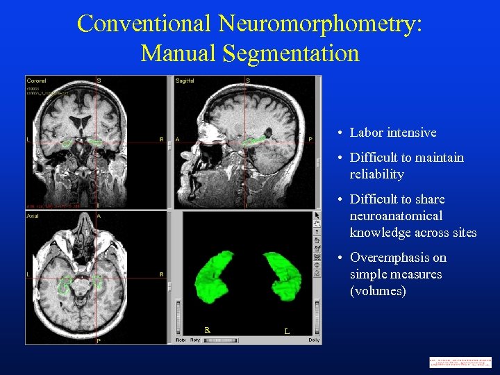 Conventional Neuromorphometry: Manual Segmentation • Labor intensive • Difficult to maintain reliability • Difficult