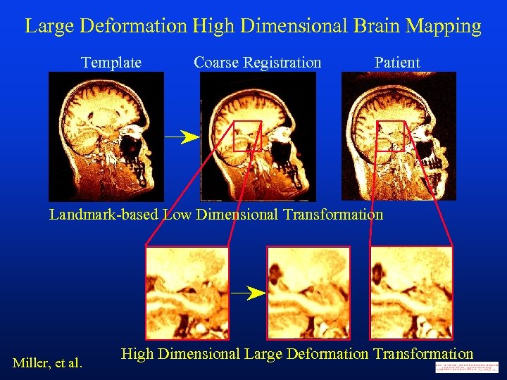 Large Deformation High Dimensional Brain Mapping Template Coarse Registration Patient Landmark-based Low Dimensional Transformation