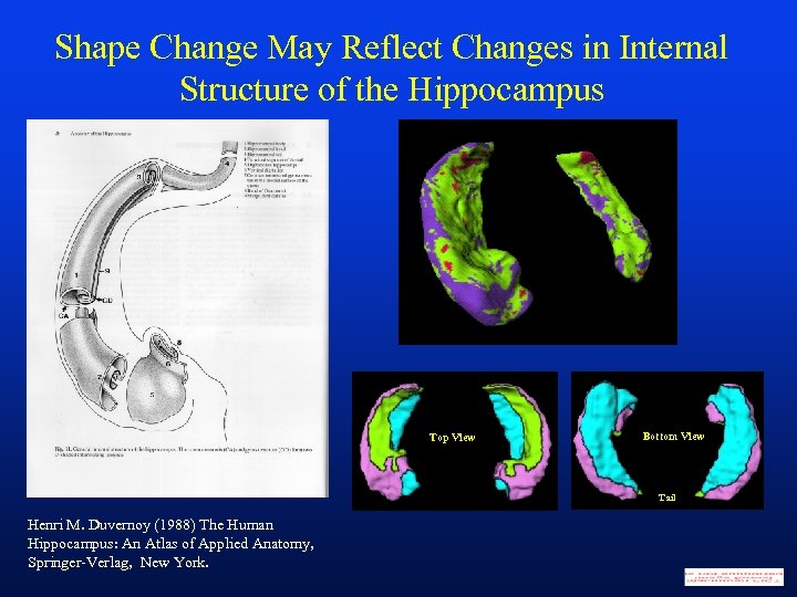 Shape Change May Reflect Changes in Internal Structure of the Hippocampus Top View Bottom