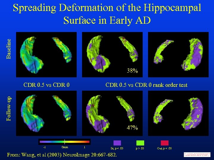 Baseline Spreading Deformation of the Hippocampal Surface in Early AD 38% CDR 0. 5