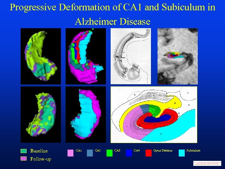 Progressive Deformation of CA 1 and Subiculum in Alzheimer Disease Baseline Follow-up CA 1