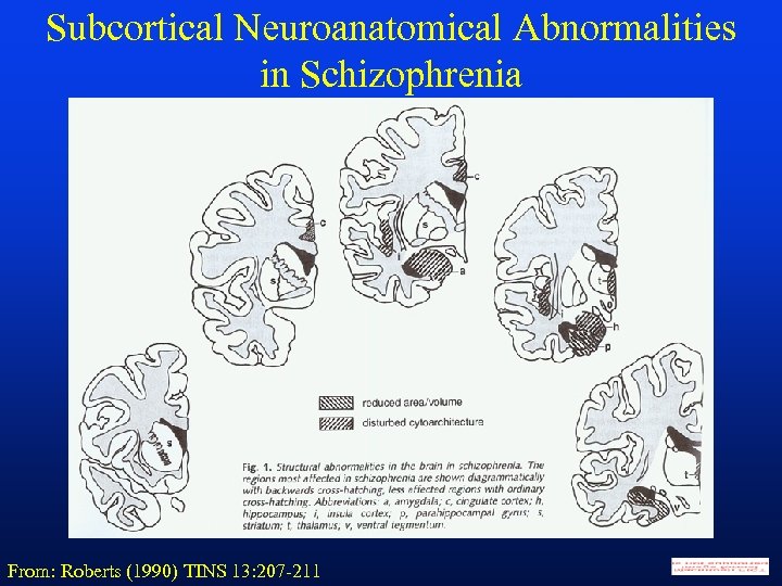 Subcortical Neuroanatomical Abnormalities in Schizophrenia From: Roberts (1990) TINS 13: 207 -211 