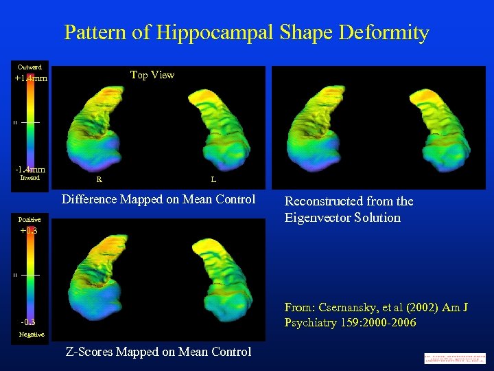 Pattern of Hippocampal Shape Deformity Outward Top View +1. 4 mm -1. 4 mm