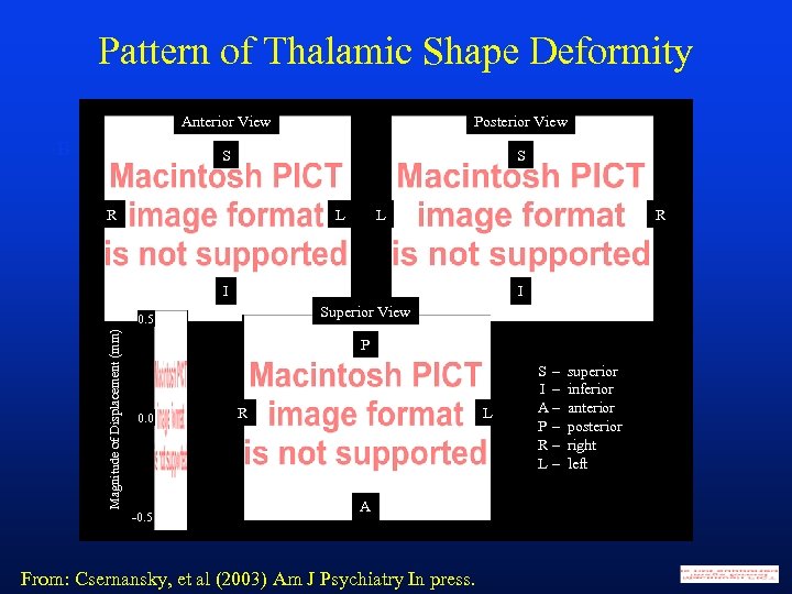 Pattern of Thalamic Shape Deformity Anterior View S B Posterior View S R L