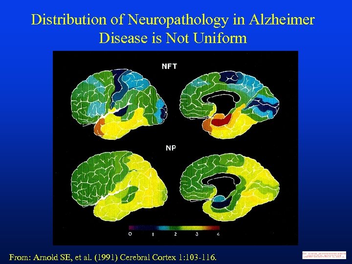 Distribution of Neuropathology in Alzheimer Disease is Not Uniform From: Arnold SE, et al.