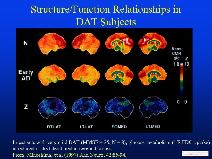 Structure/Function Relationships in DAT Subjects In patients with very mild DAT (MMSE = 25,