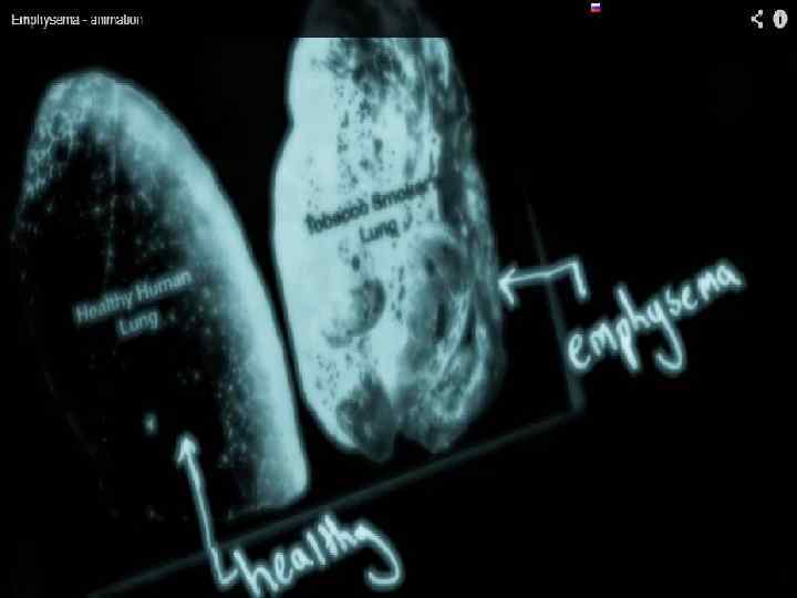 Гипофосфатемиядан пайда болатын көріністер Шаршағыштық, әлсіздік, арықтау 1 4 Миокардтың дистрофиясы, қан құйылу Бұлшықеттер
