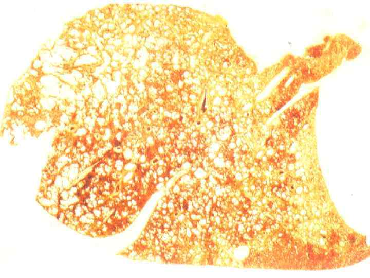 Гиперфосфатемиядан пайда болатын көріністер Бүйрек-тас ауруы Бауырдың, асқазан-ішек жолының бұзылысы 1 Сүйек тінінің декальцина