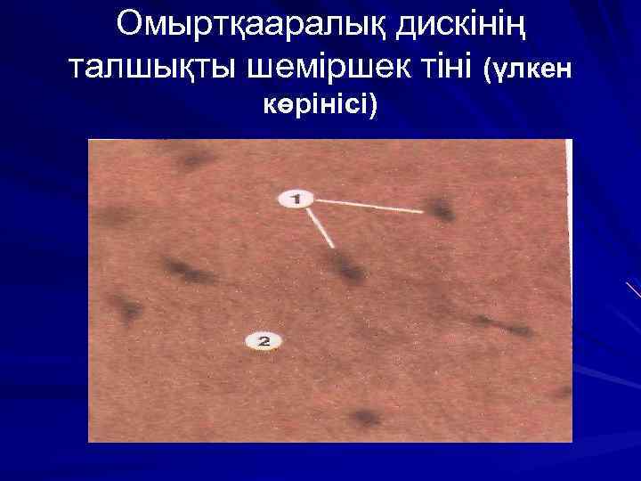 Омыртқааралық дискінің талшықты шеміршек тіні (үлкен көрінісі) 