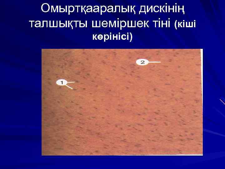 Омыртқааралық дискінің талшықты шеміршек тіні (кіші көрінісі) 