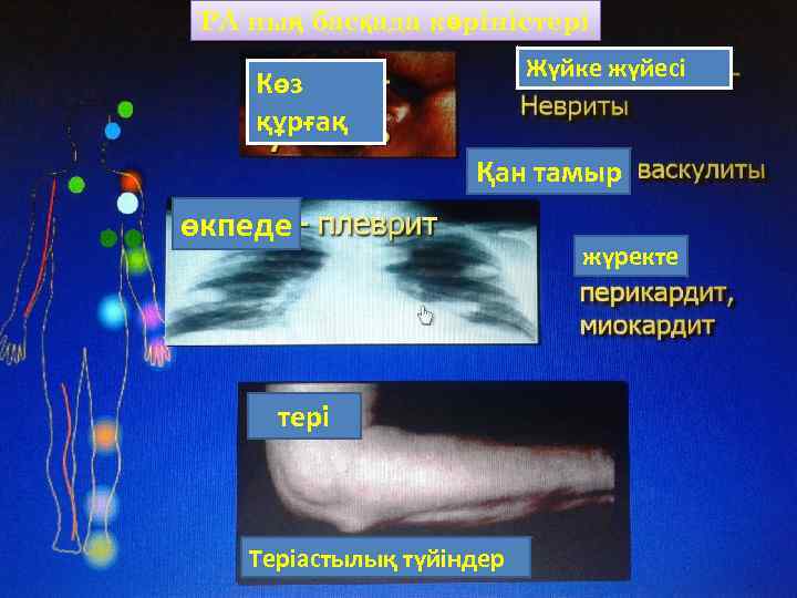 РА ның басқада көріністері Жүйке жүйесі Көз құрғақ Қан тамыр өкпеде тері Теріастылық түйіндер