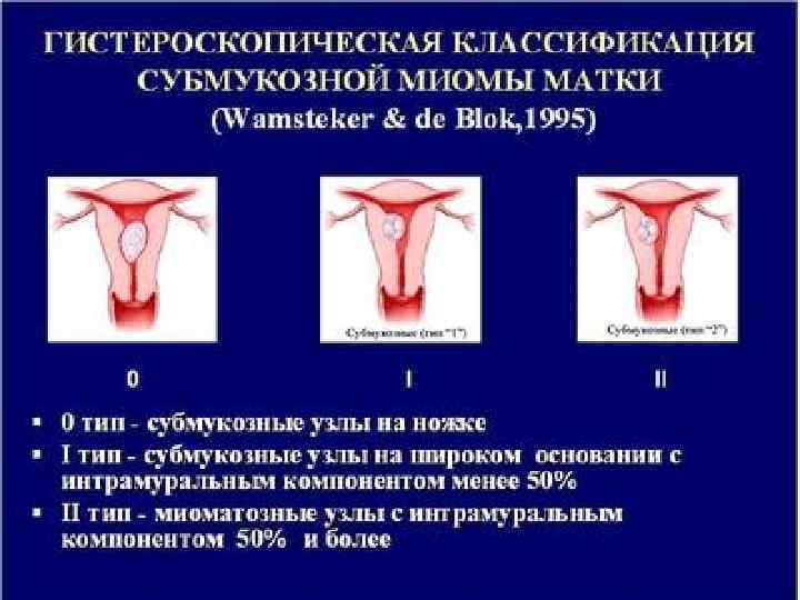 Субмукозная матка