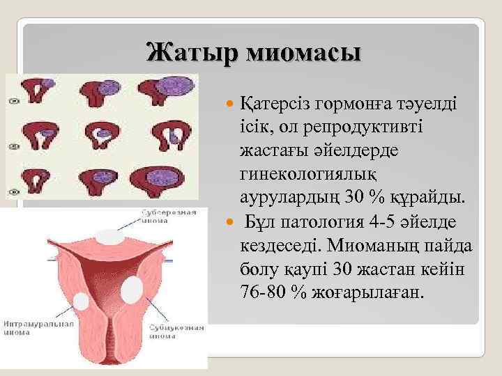 Жатыр миомасы презентация