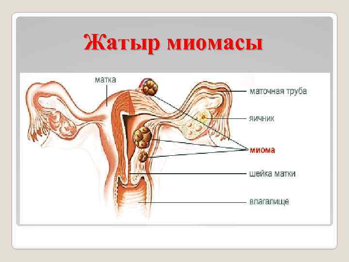 Жатыр миомасы 