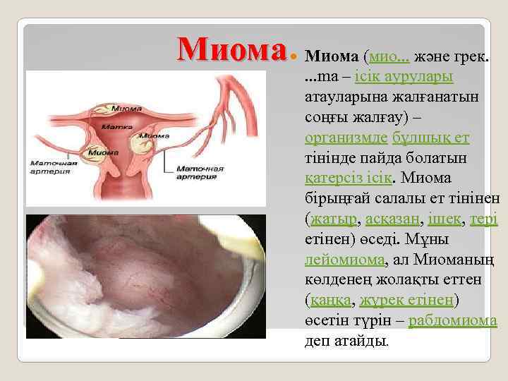 Миома (мио. . . және грек. . ma – ісік аурулары атауларына жалғанатын соңғы