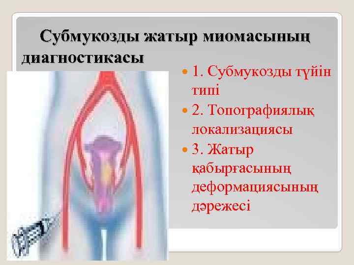 Субмукозды жатыр миомасының диагностикасы 1. Субмукозды түйін типі 2. Топографиялық локализациясы 3. Жатыр қабырғасының