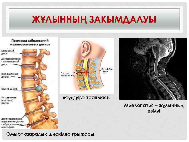 ЖҰЛЫННЫҢ ЗАКЫМДАЛУЫ «сүңгуір» травмасы Миелопатия – жұлынның езілуі Омыртқааралық дискілер грыжасы 