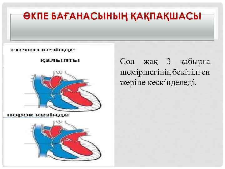 ӨКПЕ БАҒАНАСЫНЫҢ ҚАҚПАҚШАСЫ Сол жақ 3 қабырға шеміршегінің бекітілген жеріне кескінделеді. 