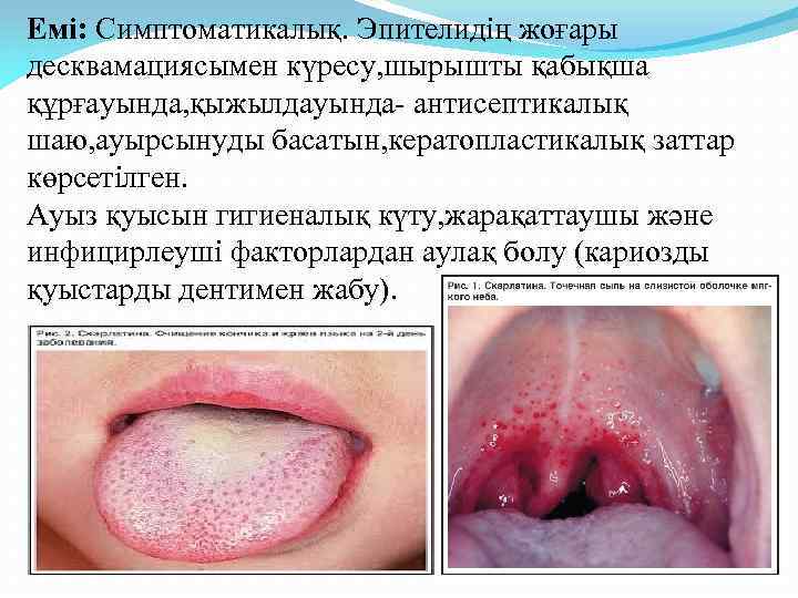 Емі: Симптоматикалық. Эпителидің жоғары десквамациясымен күресу, шырышты қабықша құрғауында, қыжылдауында- антисептикалық шаю, ауырсынуды басатын,
