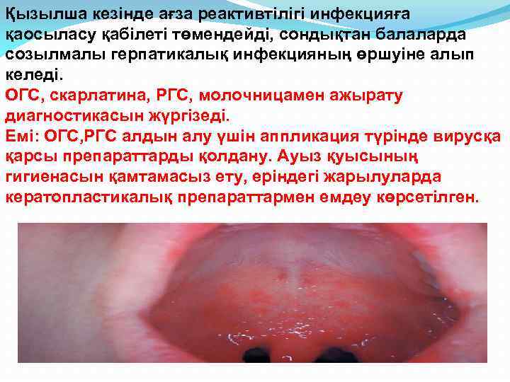 Қызылша кезінде ағза реактивтілігі инфекцияға қаосыласу қабілеті төмендейді, сондықтан балаларда созылмалы герпатикалық инфекцияның өршуіне