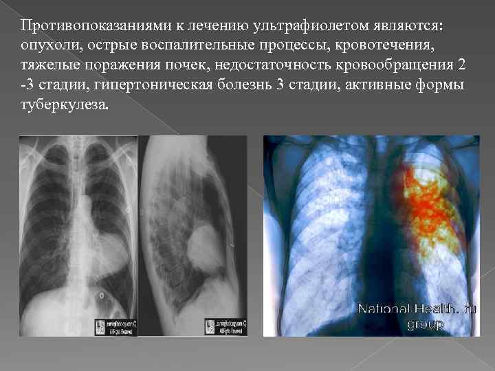 Противопоказаниями к лечению ультрафиолетом являются: опухоли, острые воспалительные процессы, кровотечения, тяжелые поражения почек, недостаточность