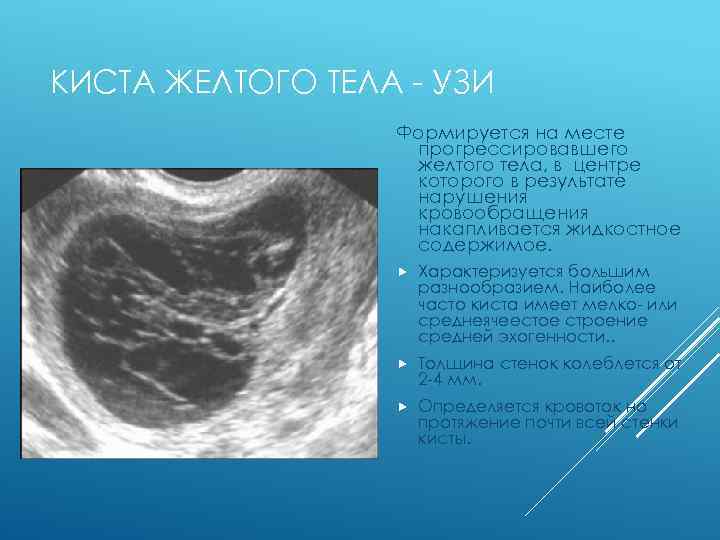 КИСТА ЖЕЛТОГО ТЕЛА - УЗИ Формируется на месте прогрессировавшего желтого тела, в центре которого