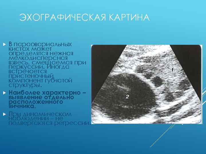 ЭХОГРАФИЧЕСКАЯ КАРТИНА В параовариальных кистах может определятся нежная мелкодисперсная взвесь, смещаемая при перкуссии. Иногда