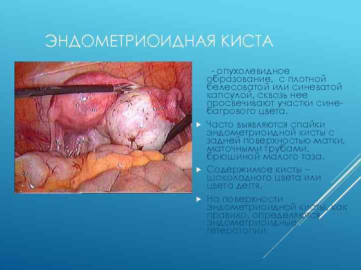 ЭНДОМЕТРИОИДНАЯ КИСТА - опухолевидное образование, с плотной белесоватой или синеватой капсулой, сквозь нее просвечивают