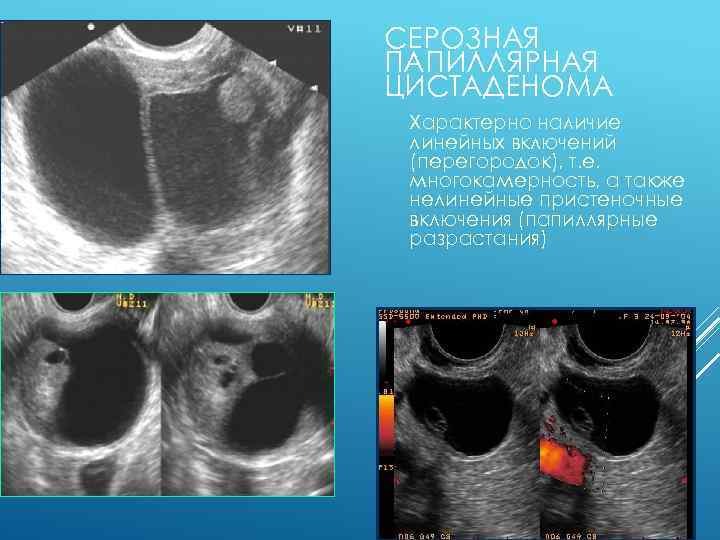 СЕРОЗНАЯ ПАПИЛЛЯРНАЯ ЦИСТАДЕНОМА Характерно наличие линейных включений (перегородок), т. е. многокамерность, а также нелинейные