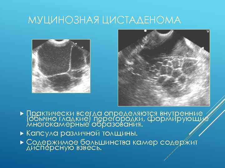 МУЦИНОЗНАЯ ЦИСТАДЕНОМА Практически всегда определяются внутренние (обычно гладкие) перегородки, формирующие многокамерные образования. Капсула различной